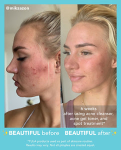 Acne Foam Cleanser